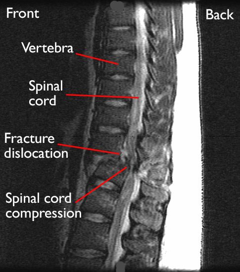 Fracture-dislocation in the thoracic spine