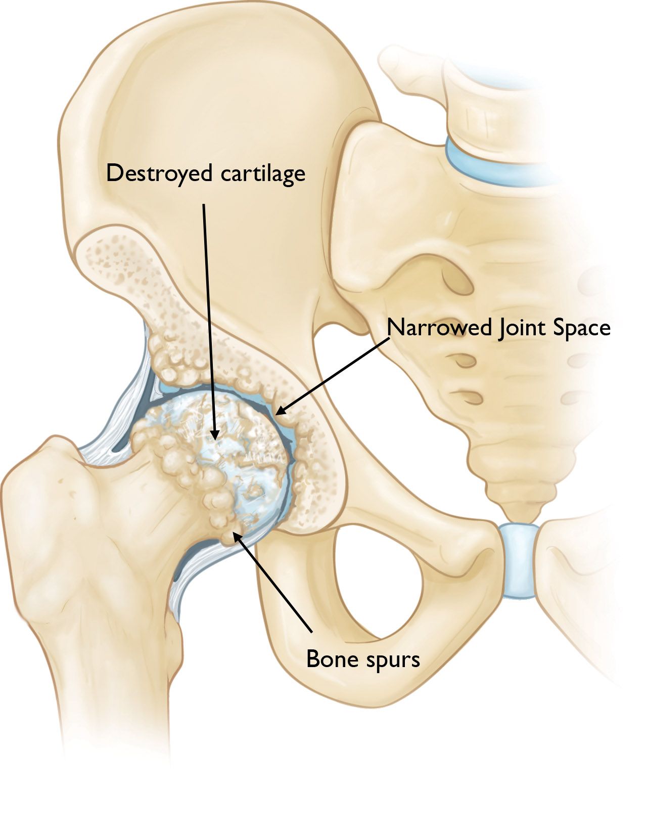 Hip Osteoarthritis OrthoInfo AAOS