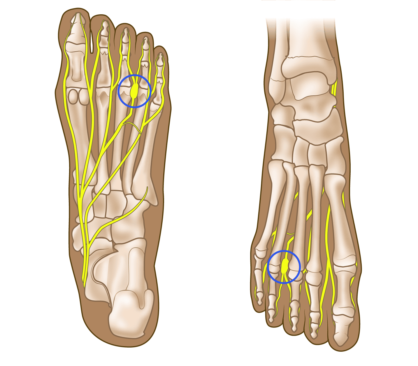 Morton s Neuroma OrthoInfo AAOS