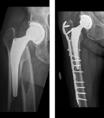 x-ray of periprosthetic hip fracture