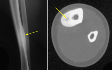 X-ray and CT scan of an osteoid osteoma in the tibia