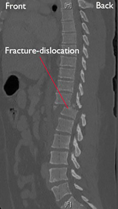 CT scan of fracture-dislocation in thoracic spine