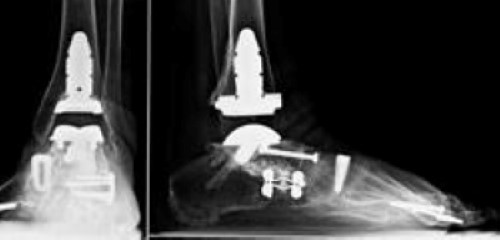 Ankle fusion and ankle replacement