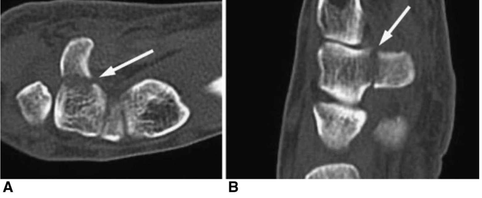 Hook of the Hamate Fracture of the Wrist - OrthoInfo - AAOS