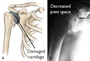 Illustration and x-ray showing osteoarthritis of the shoulder