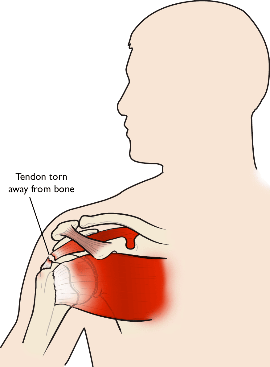 Illustration of a rotator cuff tendon torn away from bone