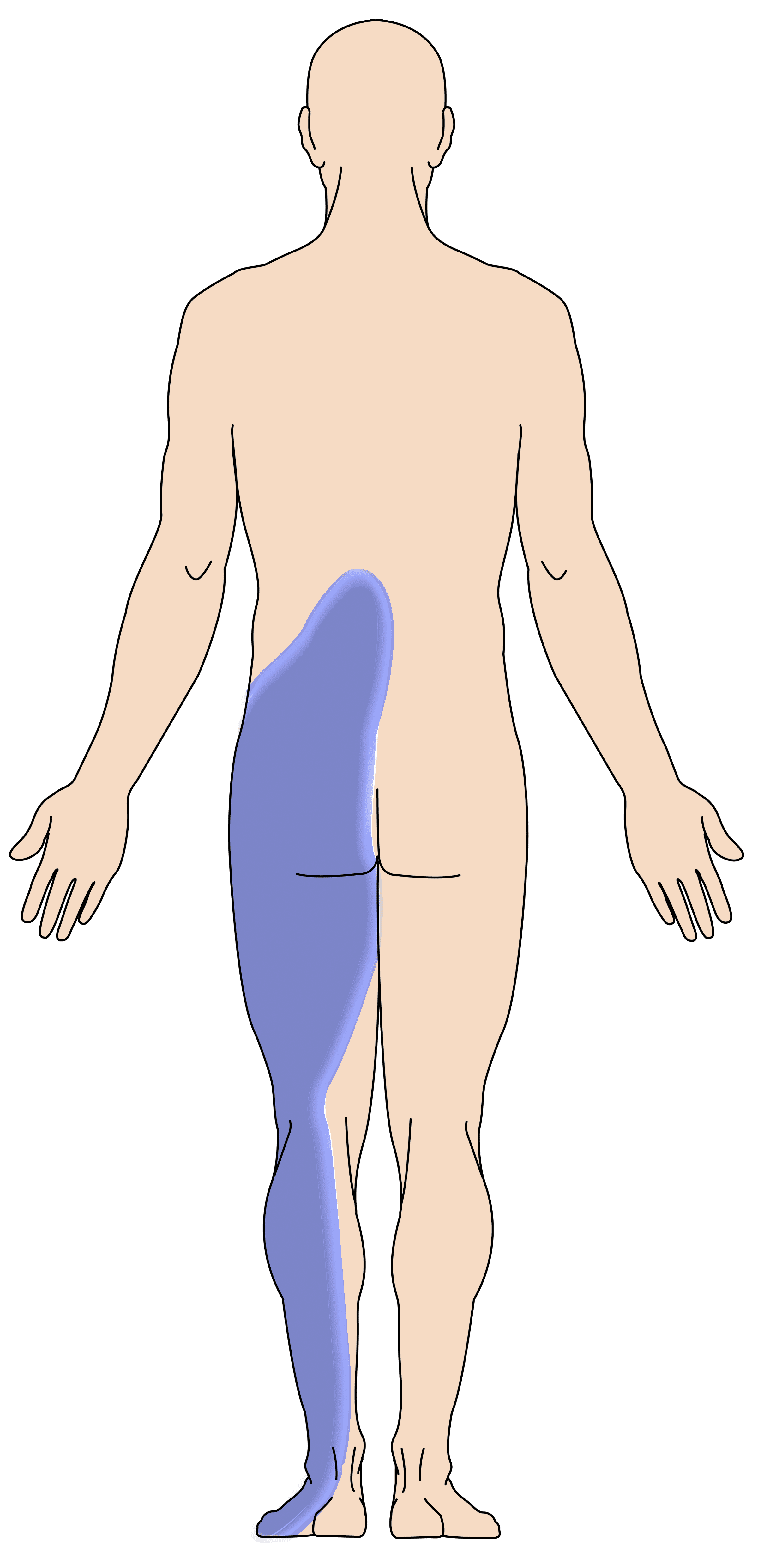 Location of back pain from spinal steonosis