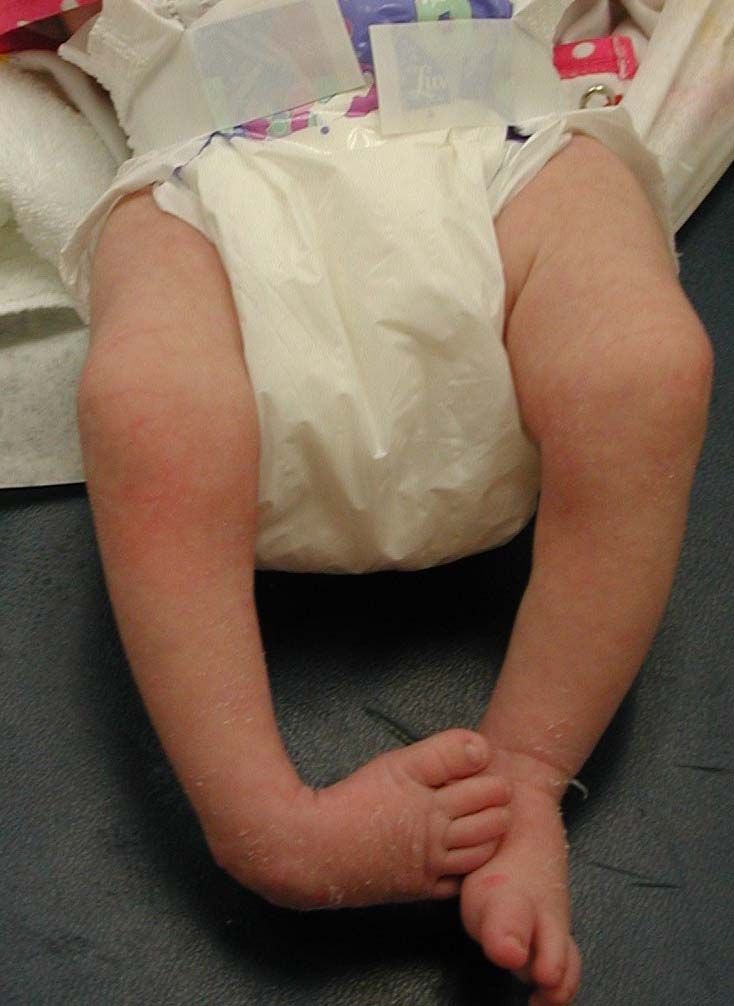 An infant with clubfoot