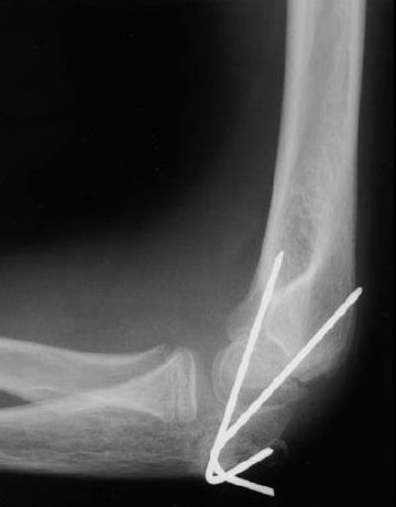 Internal fixation of elbow fracture