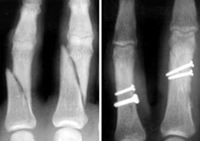 Phalanx fractures and internal fixation