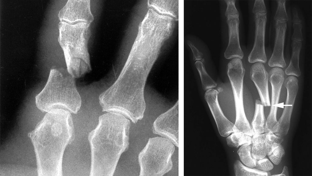 Phalanx fracture and metacarpal fracture