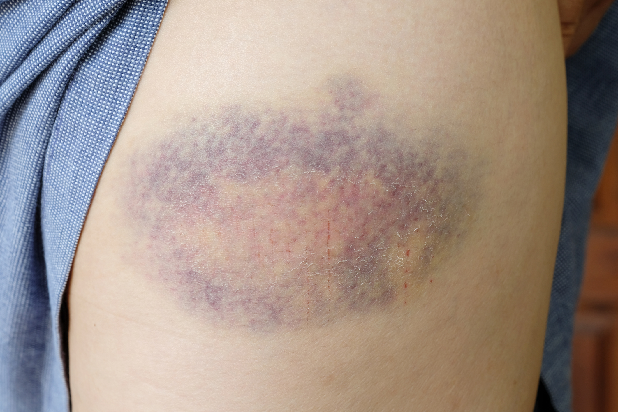 Muscle Contusion (Bruise)