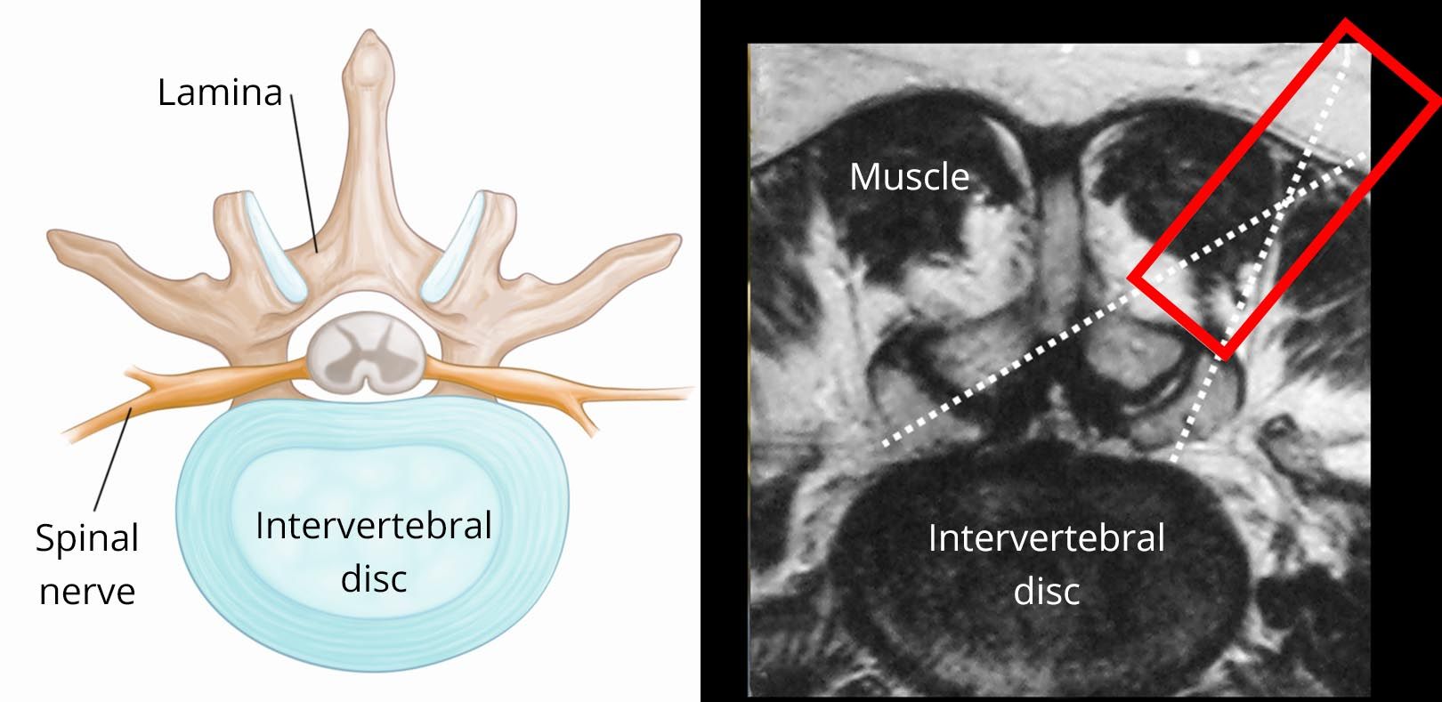 Cross-section view of intervertebral disk and location of tubular retractor
