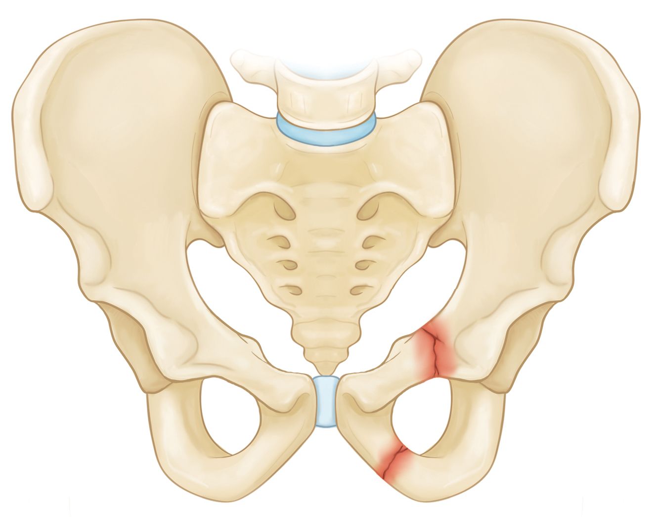 Superior and inferior pubic ramus fracture 