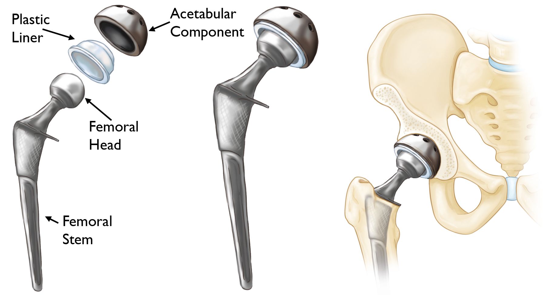 Total hip replacement implants
