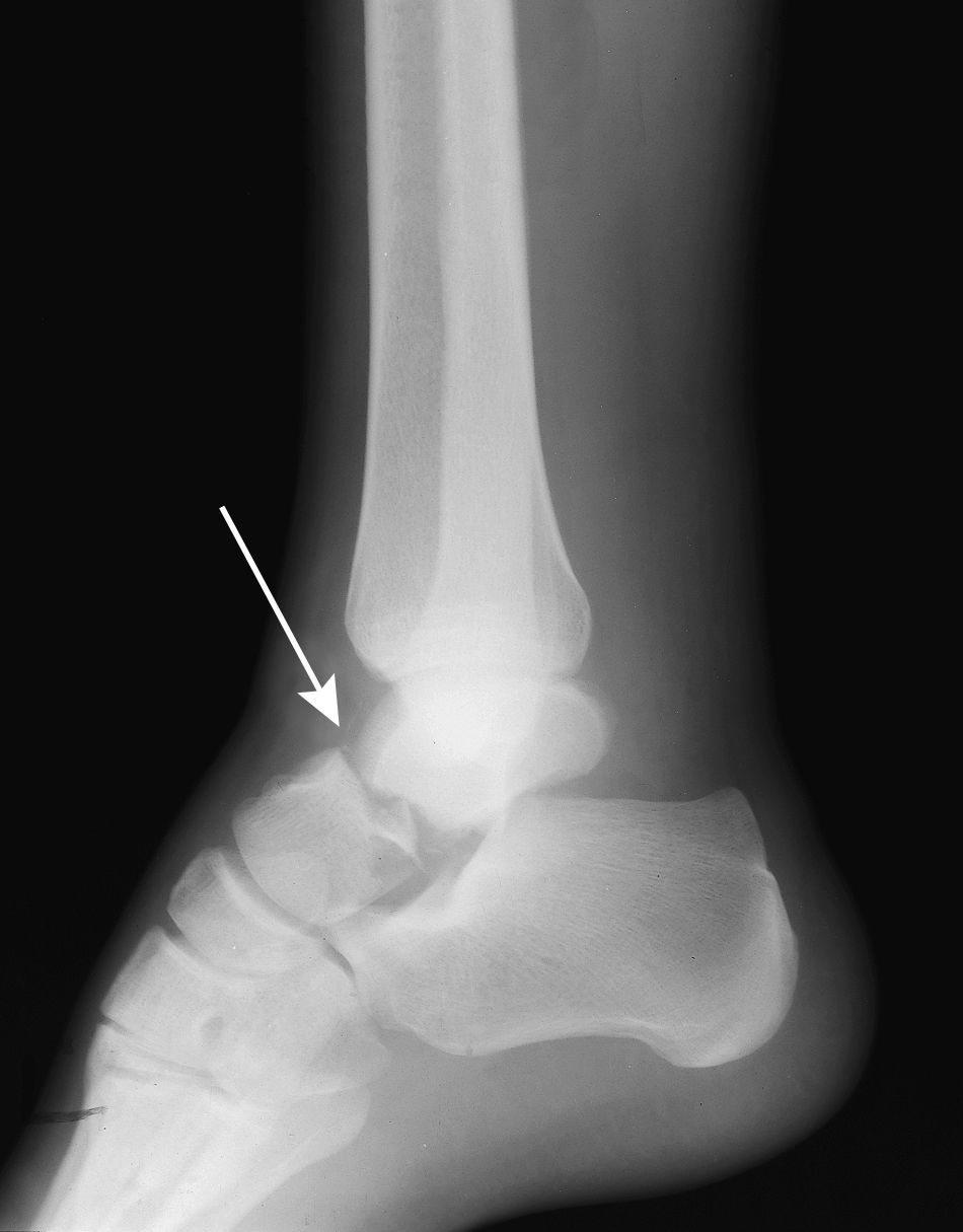 X-ray of a talus neck fracture. 