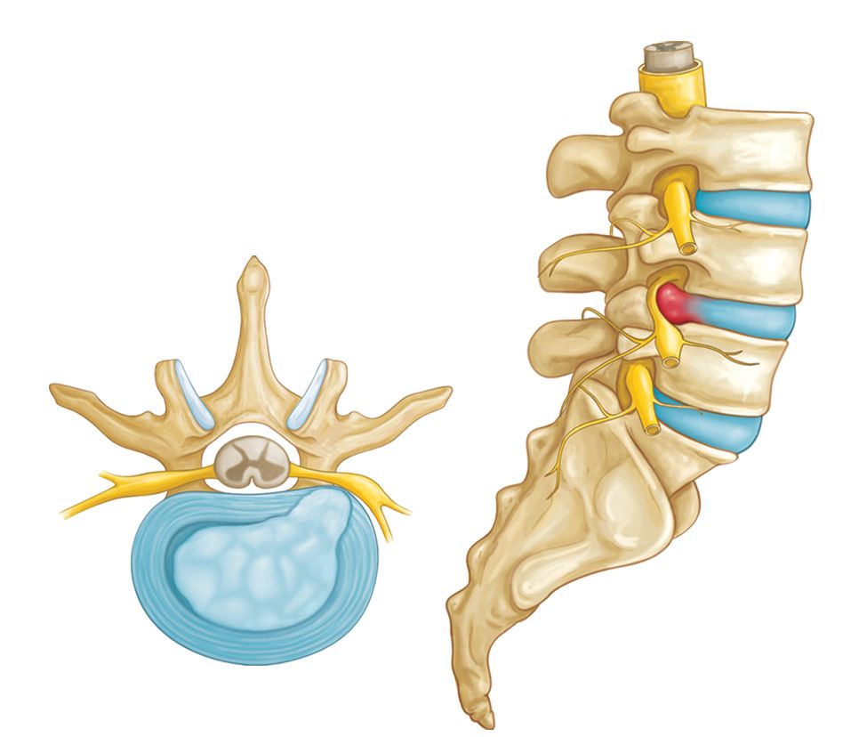 Herniated disk