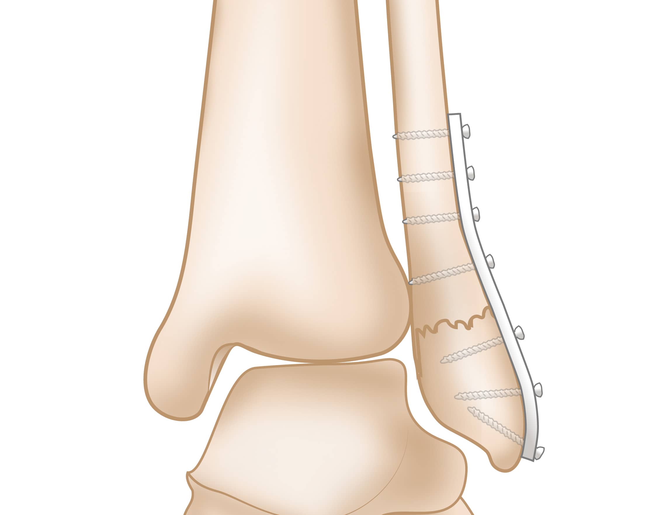 Surgically Repaired Displaced Lateral Malleolus Fracture