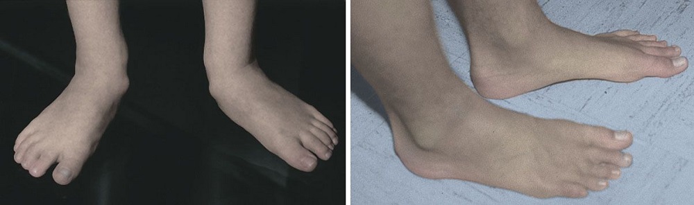 Flexible flatfoot corrected over time