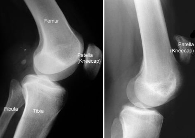 x-rays of normal knee and knee with torn patellar tendon