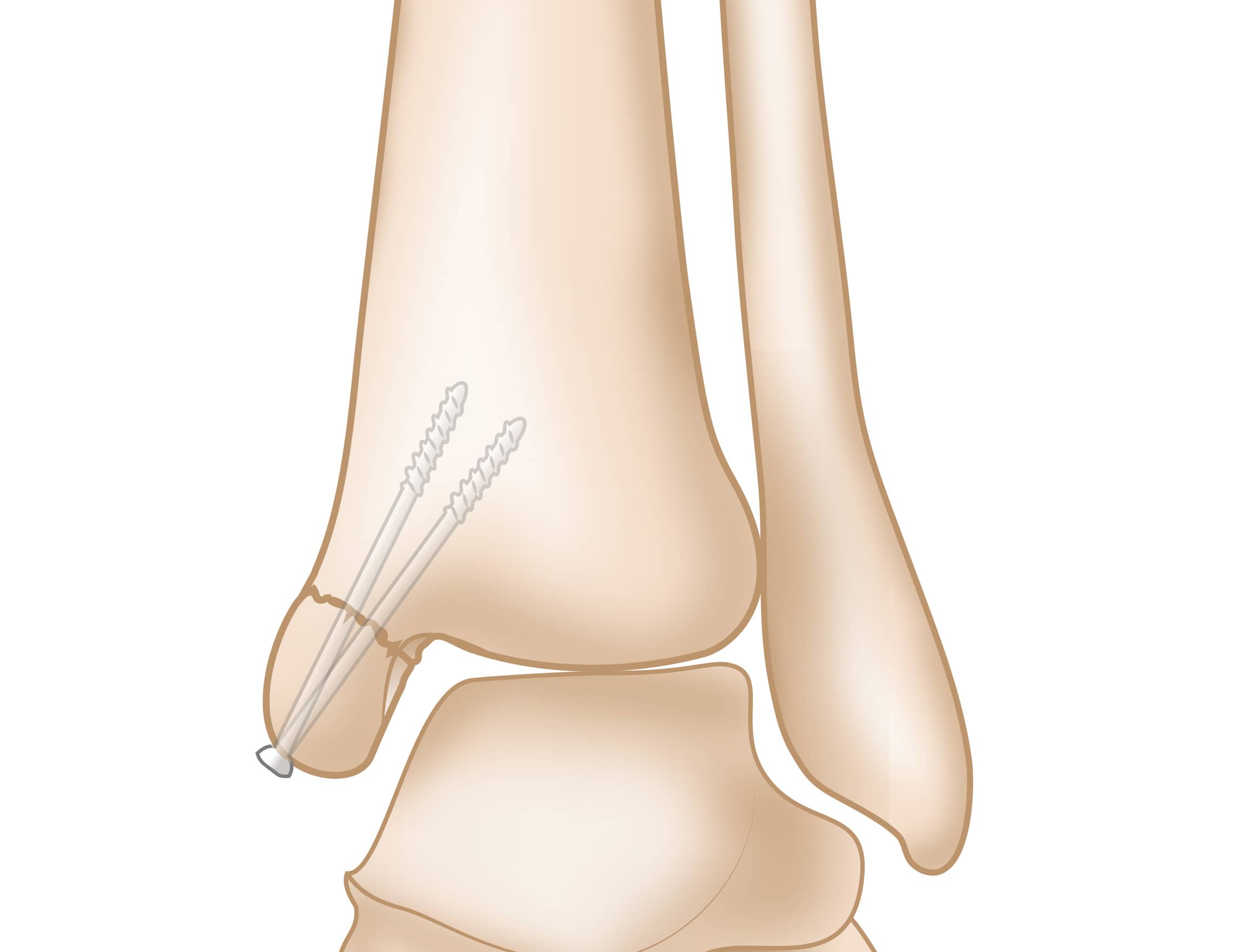 Repaired Medial Malleolus Fracture