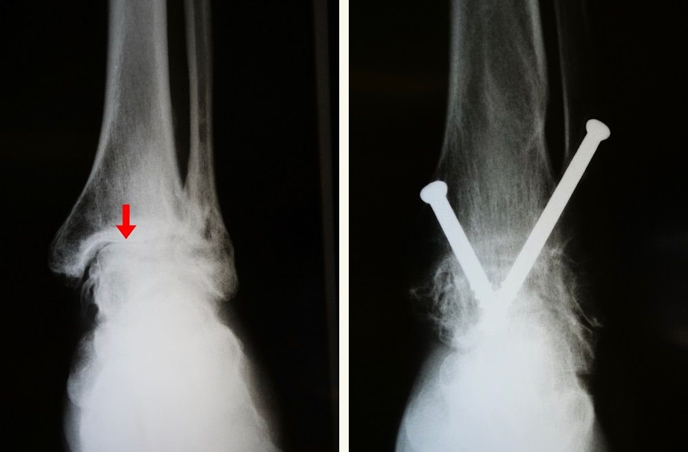 x-rays of ankle arthritis and arthrodesis (fusion)