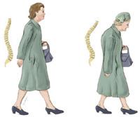 Illustration of the stooped appearance of a person with osteoporosis