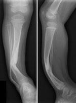 Neurofibromatosis - Types and Treatments - OrthoInfo - AAOS