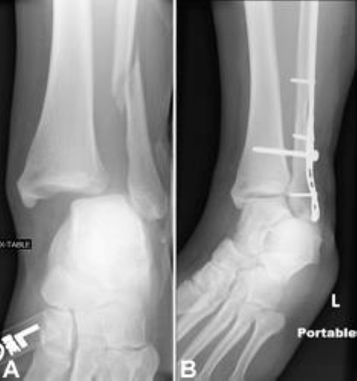 X-ray of syndesmotic injury with lateral malleolus fracture