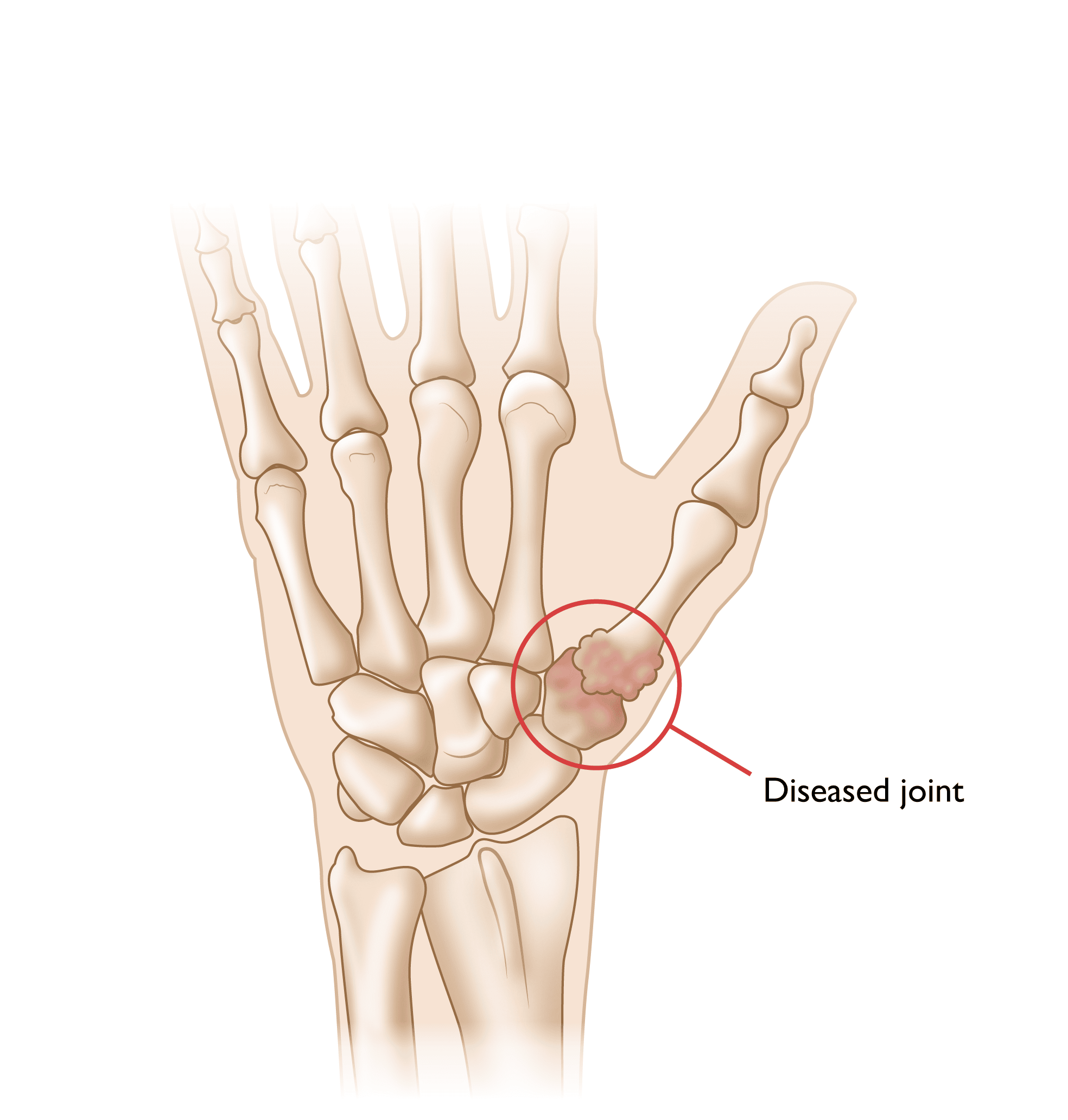 Arthritis Of The Thumb OrthoInfo AAOS