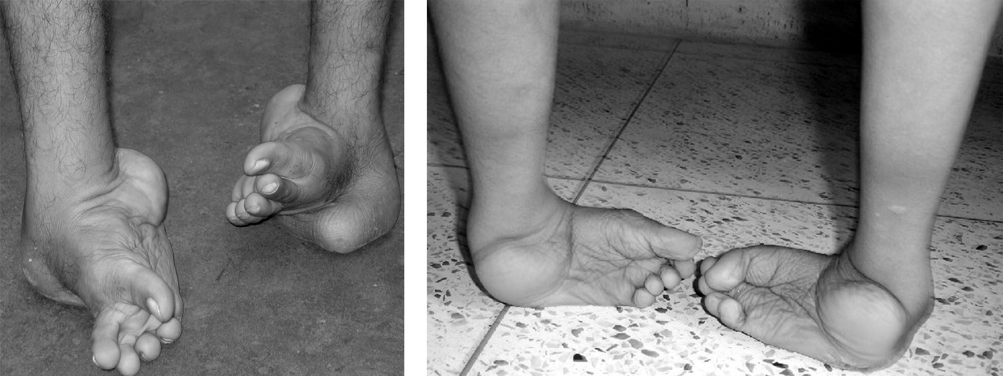 Untreated clubfoot that has result in serious disability