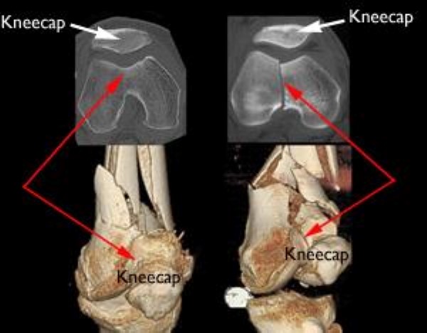 CT scans and 3-dimensional models of distal femur fractures