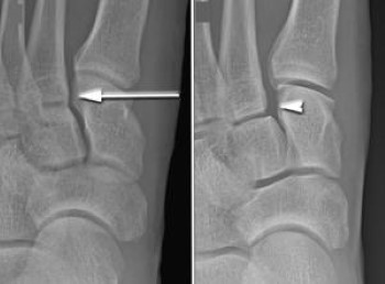 X-rays of Lisfranc injury