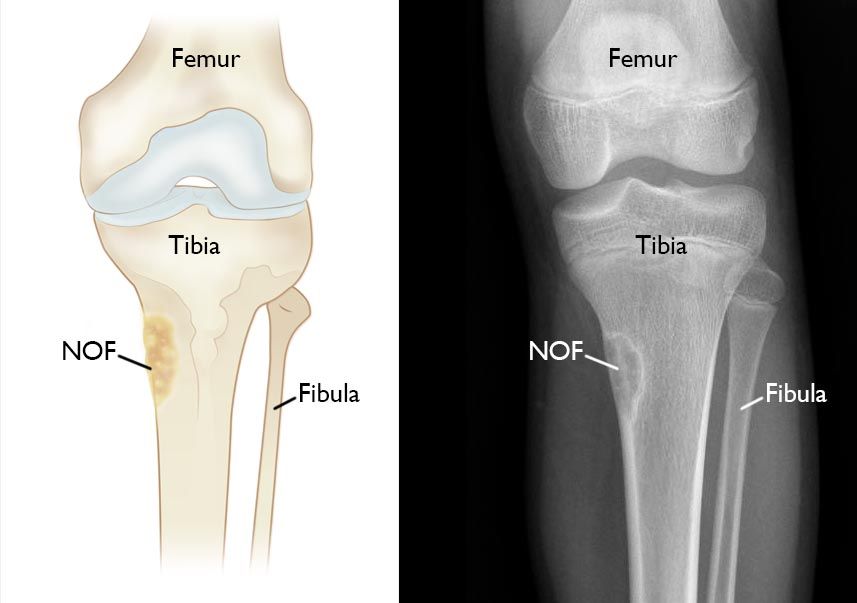 x-ray and illustration of NOF in tibia