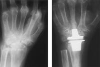 Wrist joint replacement
