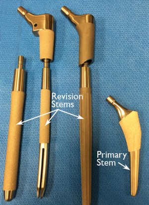 Revision hip implants