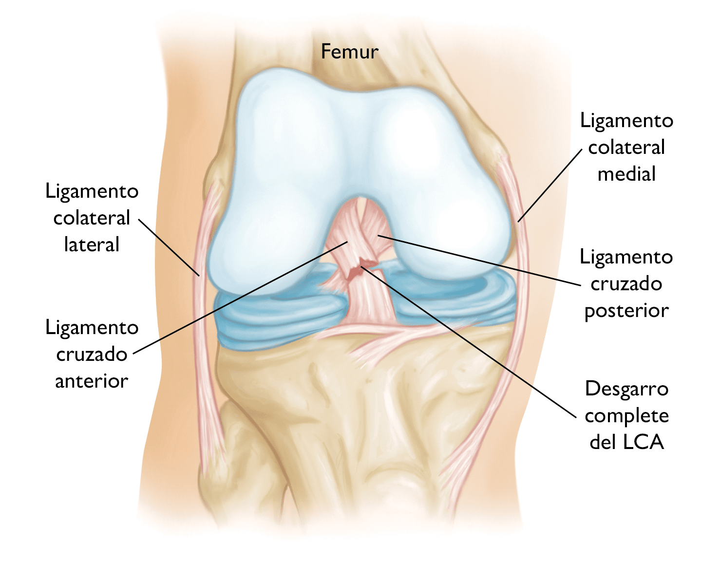 Lesiones Del Ligamento Cruzado Anterior Lca Anterior Cruciate Ligament Acl Injuries