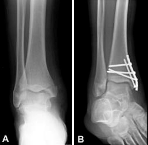 X-ray of a medial malleolus fracture and treatment