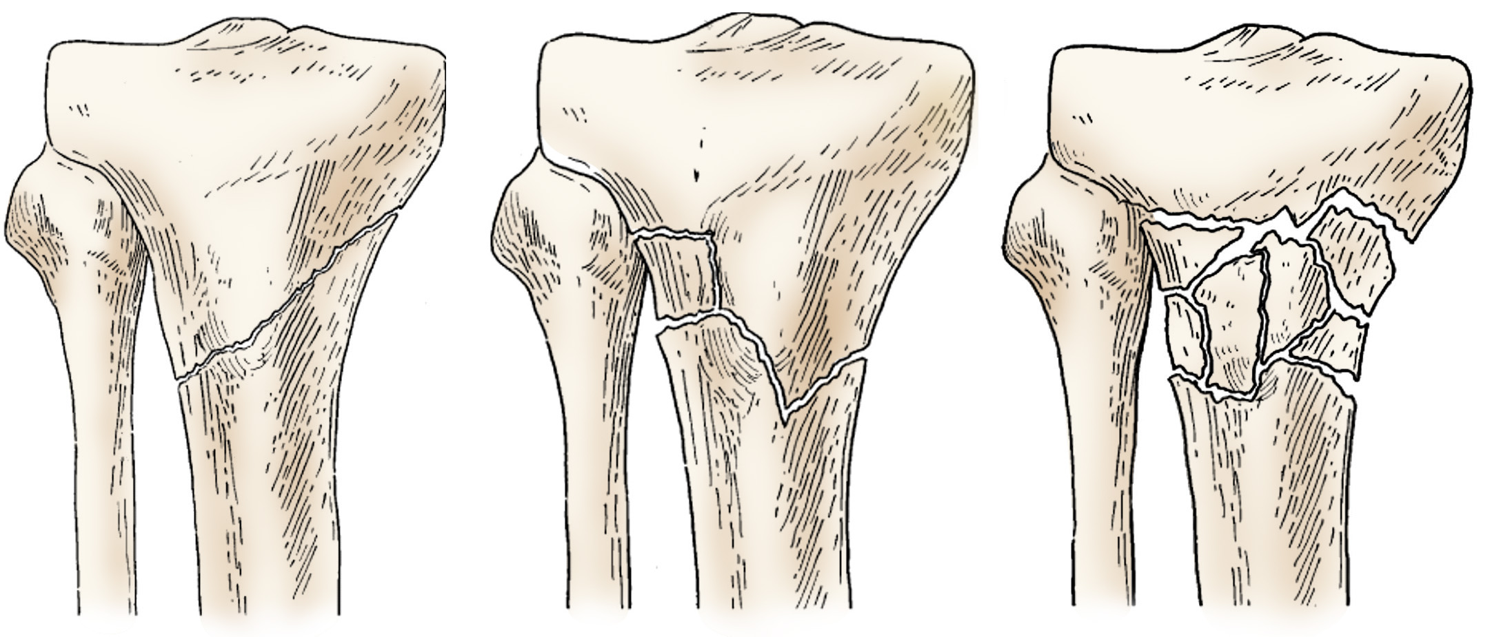 Illustration of different proximal tibia fractures