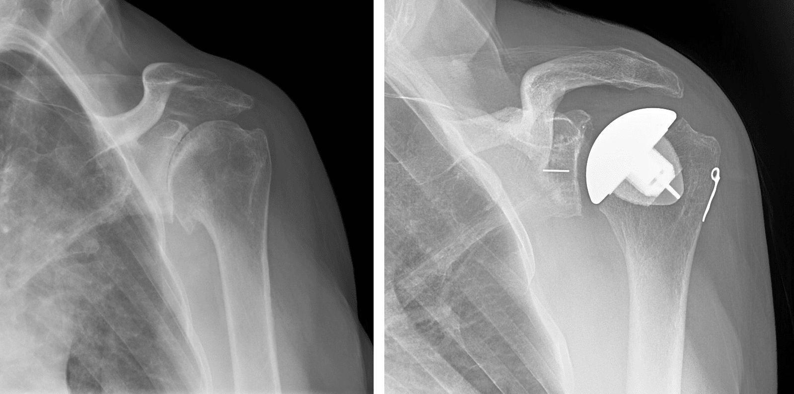 Before and after total shoulder replacement