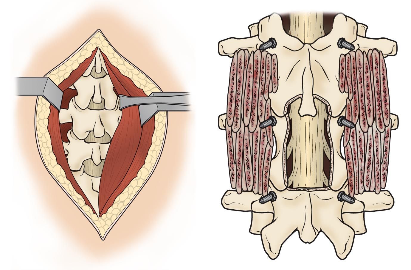 Spine decompression and bone graft