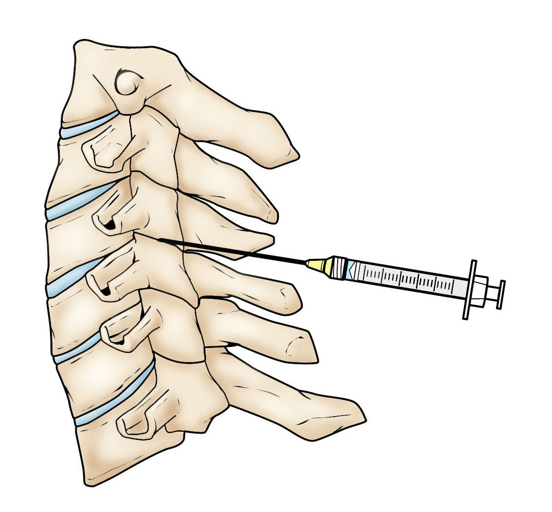 injection in the cervical spine. 