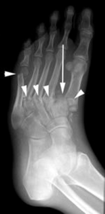 fractures and dislocation of metatarsals