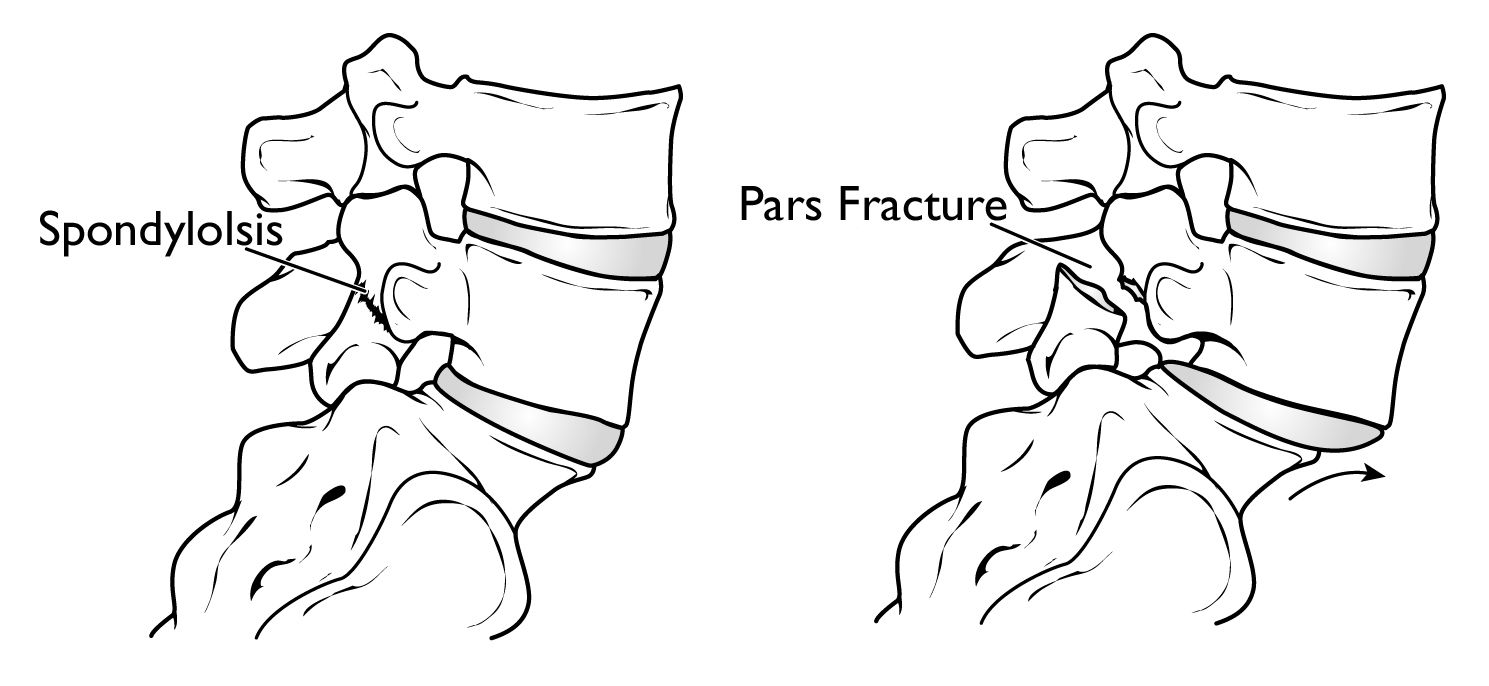 Illustration of a pars fracture and spondylolisthesis