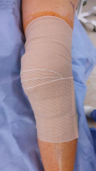 Bandage covering arthroscopic incisions