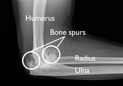 x-ray of elbow osteoarthritis