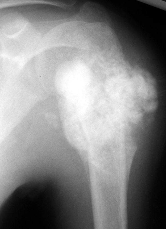 X-ray of osteosarcoma in upper arm bone