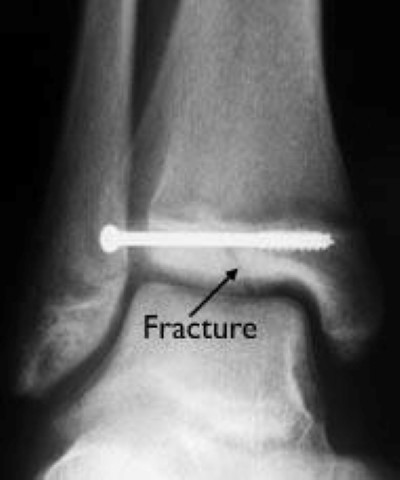 Tillaux fracture surgical fixation