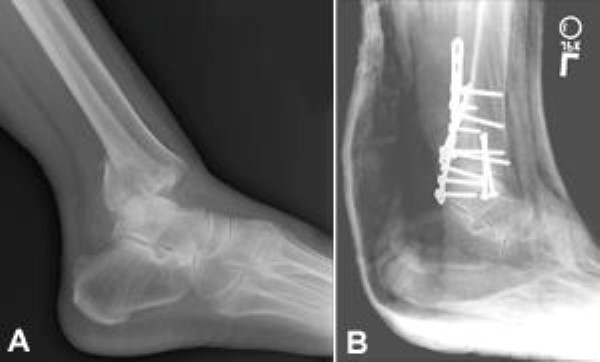 X-ray of trimalleolar ankle fracture and surgical repair