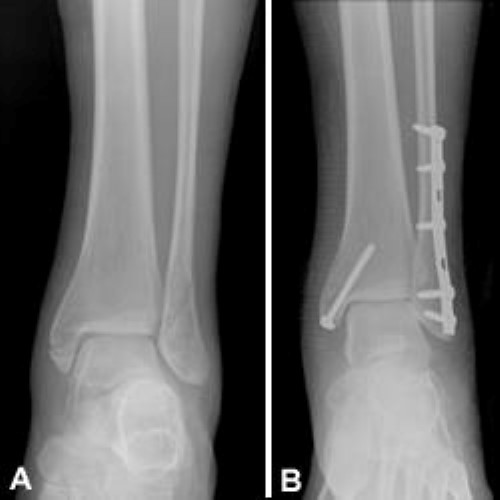 bimalleolar ankle fracture and surgical repair
